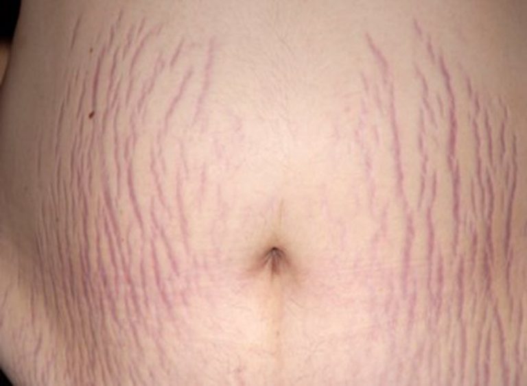 Stretch Marks Treatment Dr Brad's Laser and Cosmetic Clinic, Bristol