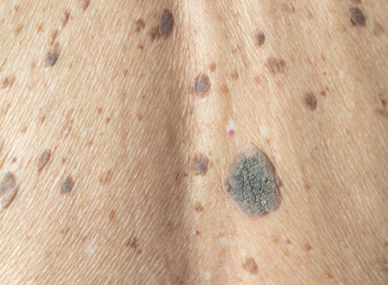 Seborrhoeic Keratosis Dr Brad S Laser And Cosmetic Clinic Bristol